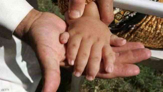 طفل يحتفل بالذكرى الأولى لزراعة يديه