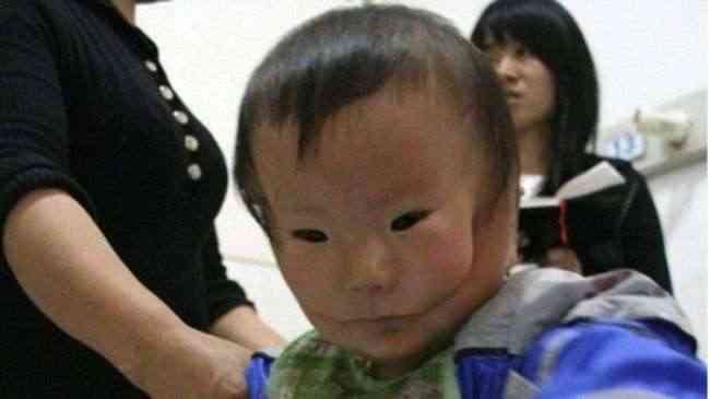 طفل صيني بوجهين يصدم الأطباء