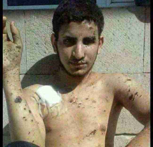 آثار تعذيب وحشية بجسد مختطف أُفرج عنه من سجون الحوثي .. صورة