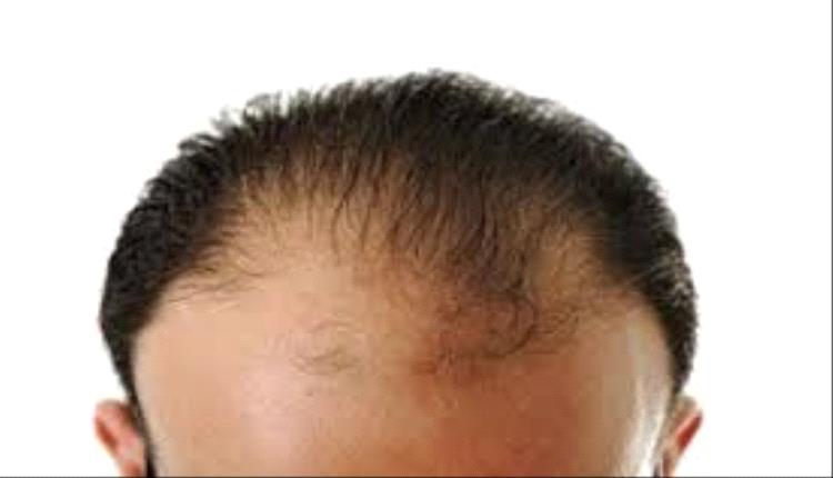 نقص هذا الفيتامين بالجسم يؤدي إلى تساقط الشعر