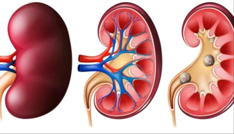 بعض أدوية السكري تخفّض خطر الإصابة بحصوات الكلى