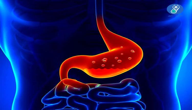 متى تشكل حرقة المعدة خطورة؟ إليك الإجابة