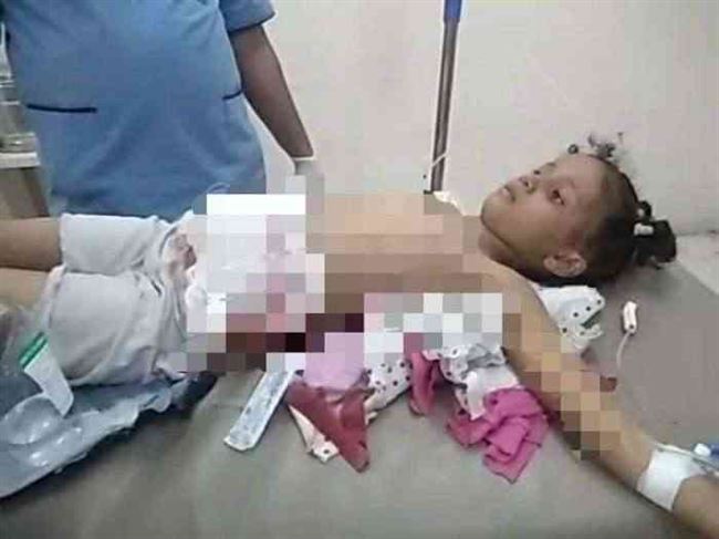 الطفلة نهال تفارق الحياة متأثرة بإصابتها برصاصة قناص حوثي في تعز