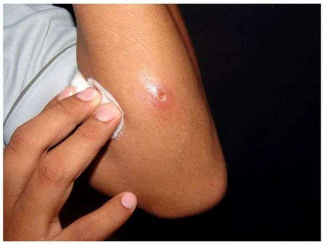 الصحة العالمية: تسجيل 15 ألف حالة إصابة بمرض الليشمانيا في اليمن