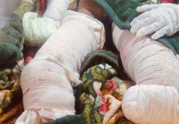 صورة مؤلمة.. شاهد ماذا فعل لغم حوثي بطفل في حجة