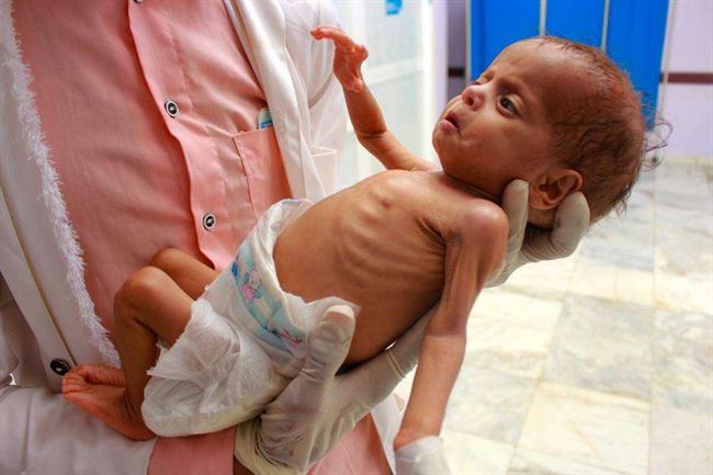 6 أعوام من دمار الحوثيين خلفت أجسادا هزيلة بالمشافي
