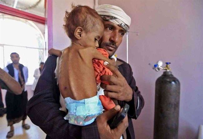 الأمم المتحدة تؤكد وصول سوء التغذية إلى مستويات قياسية في اليمن