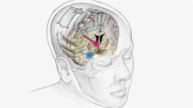 تطوير جهاز يزرع في الدماغ يمكنه علاج مرض نفسي مقاوم للأدوية