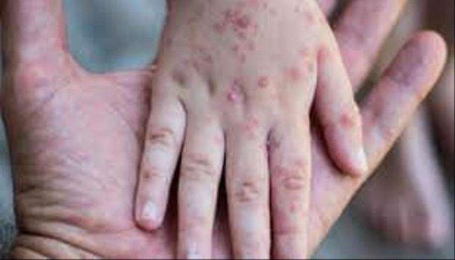 هذا العام.. إصابة أكثر من 50 ألفا بالحصبة ووفاة 568 في اليمن