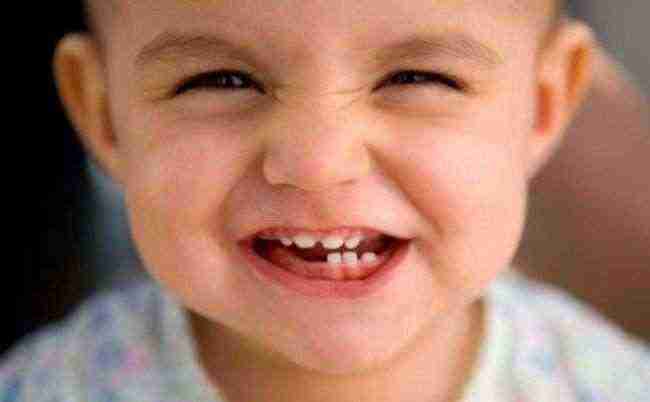 دراسة: إصابة أسنان الأطفال بالتسوس لا ترتبط بعوامل وراثية
